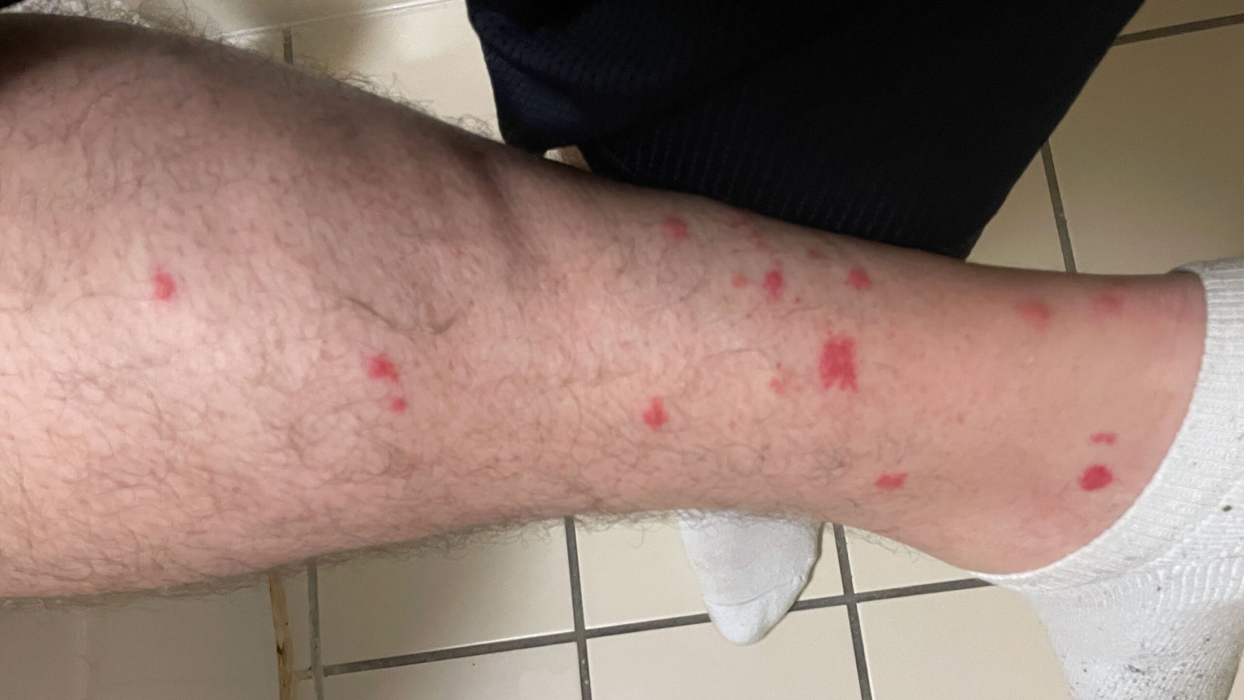 chiggers & bites on leg1