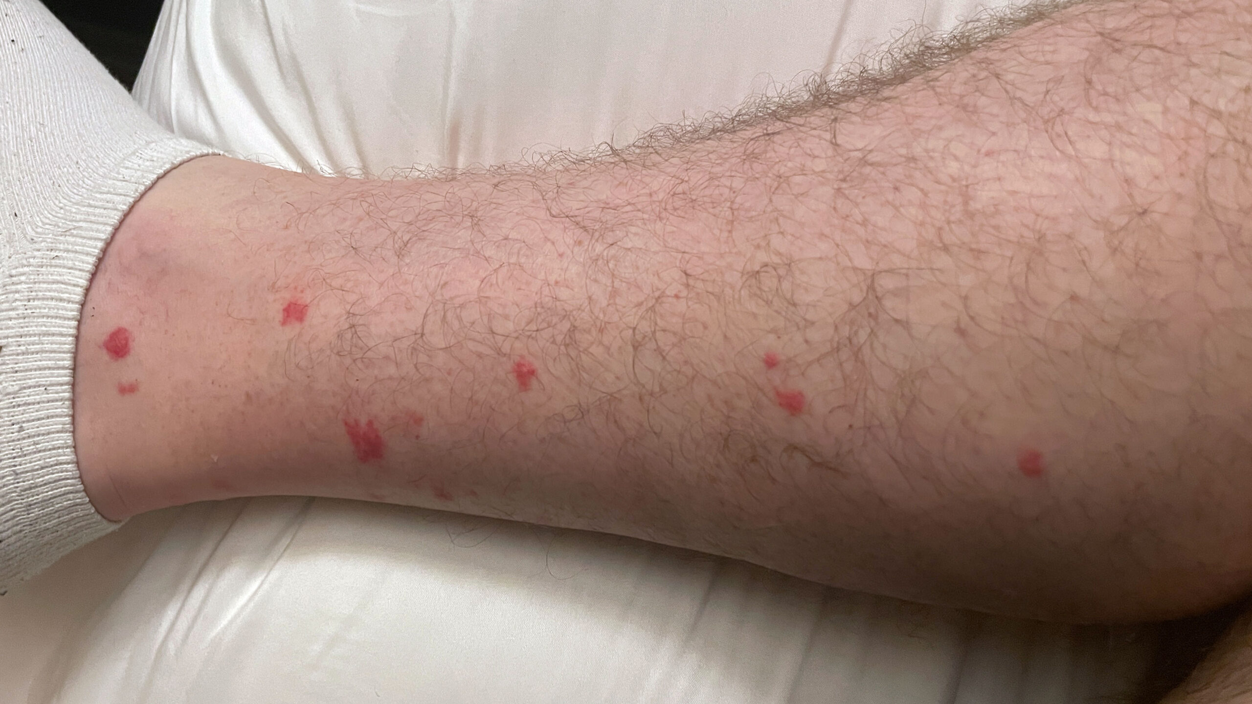 chiggers & bites on leg2