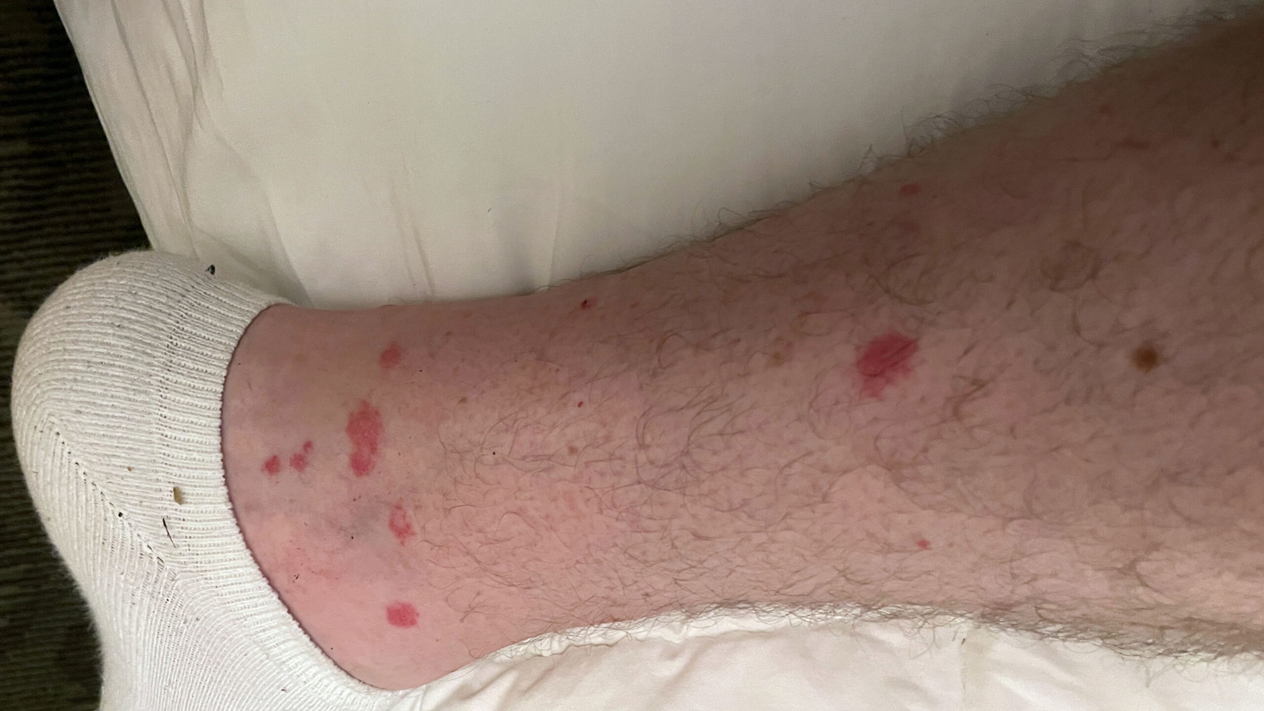 chiggers & bites on leg3