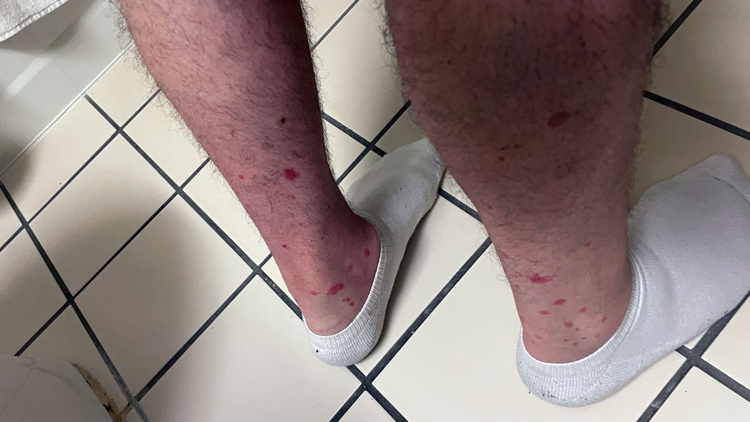 chiggers & bites on leg4